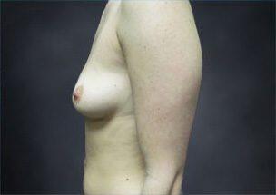 Breast Augmentation Before & After Image