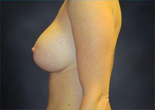 Breast Augmentation Before & After Image