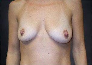 Breast Augmentation Before & After Image