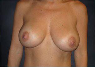 Breast Augmentation Before & After Image