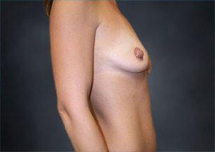 Breast Augmentation Before & After Image