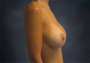 Breast Augmentation Before & After Image