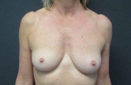 Breast Augmentation Before & After Image