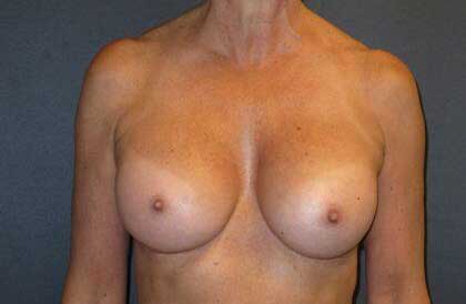 Breast Augmentation Before & After Image