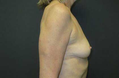 Breast Augmentation Before & After Image