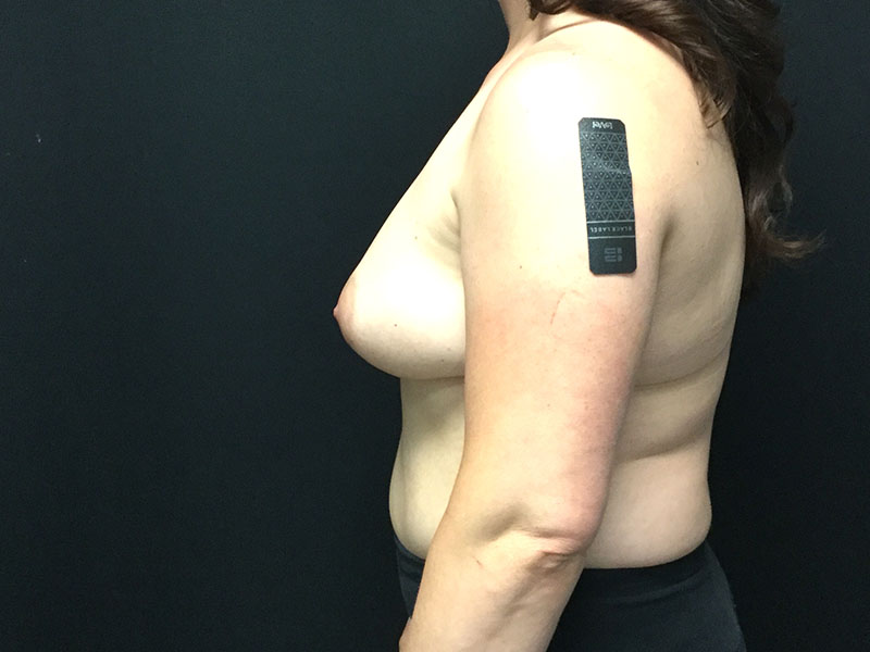 Breast Augmentation Before & After Image