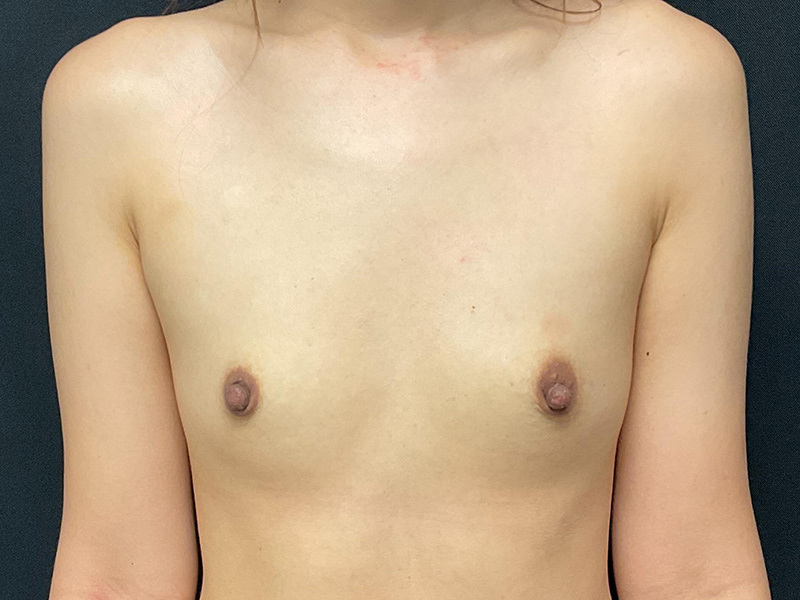 Breast Augmentation Before & After Image