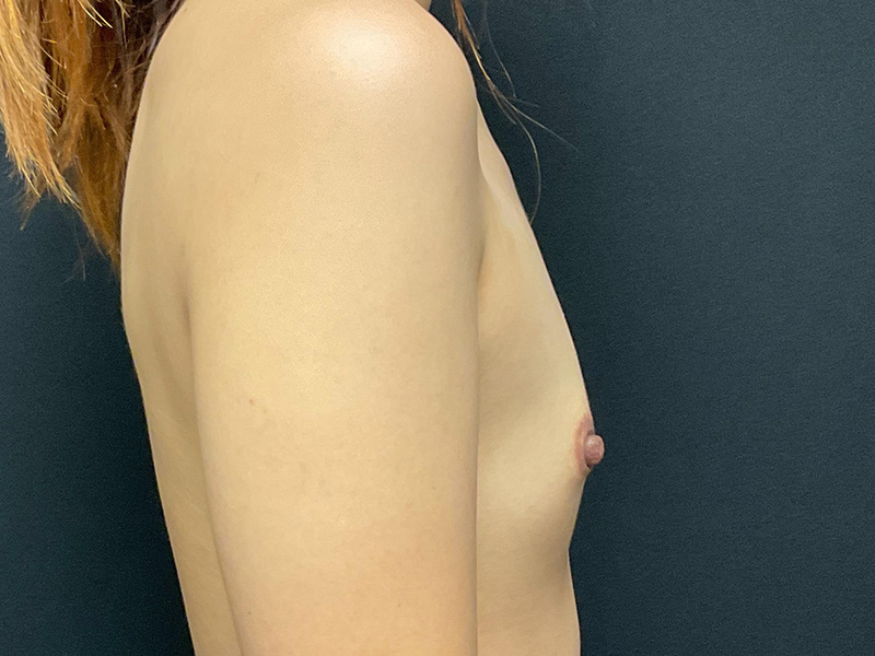 Breast Augmentation Before & After Image