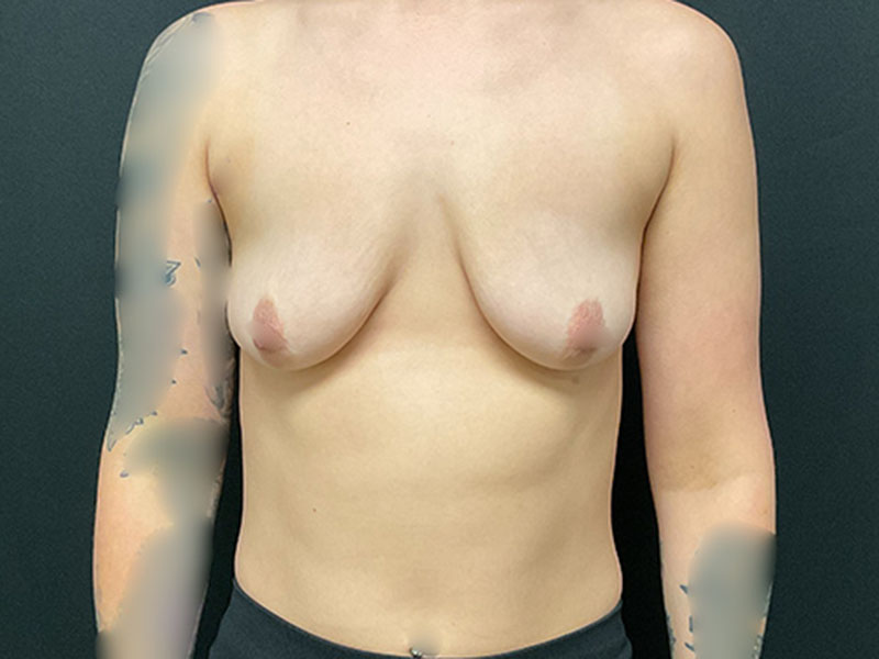 Breast Lift with Implants Before & After Image