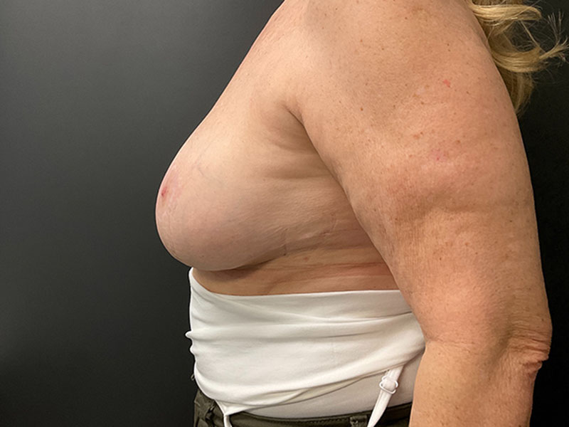 Breast Lift with Implants Before & After Image