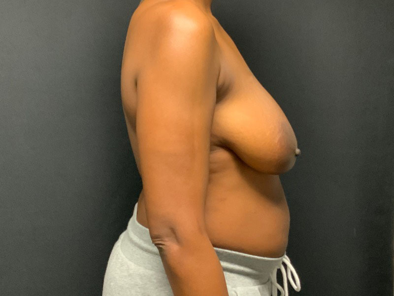 Breast Lift Before & After Image