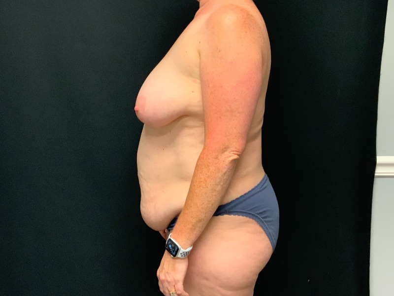 Breast Lift Before & After Image