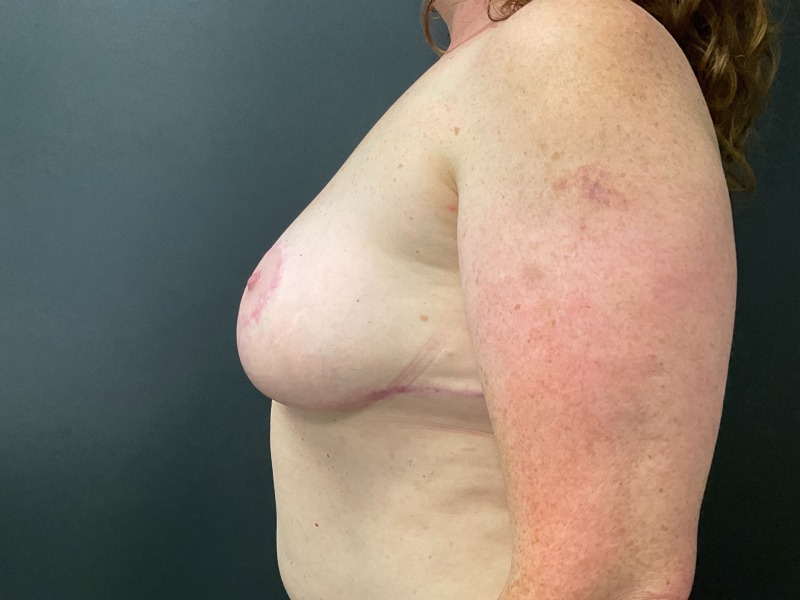 Breast Lift Before & After Image