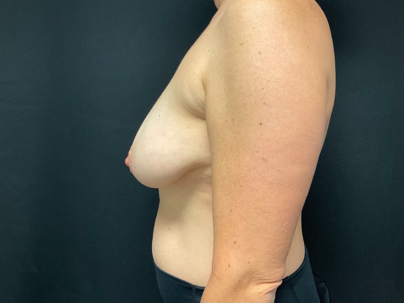 Breast Lift Before & After Image