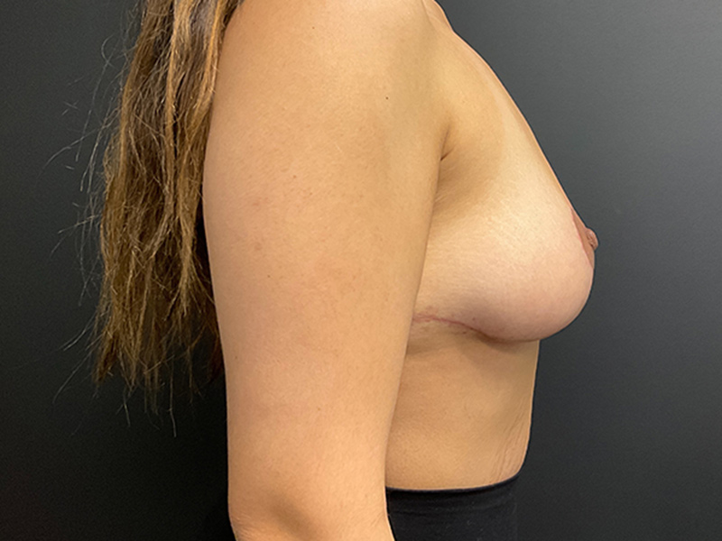 Breast Lift Before & After Image