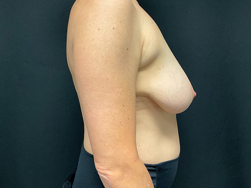 Breast Lift Before & After Image