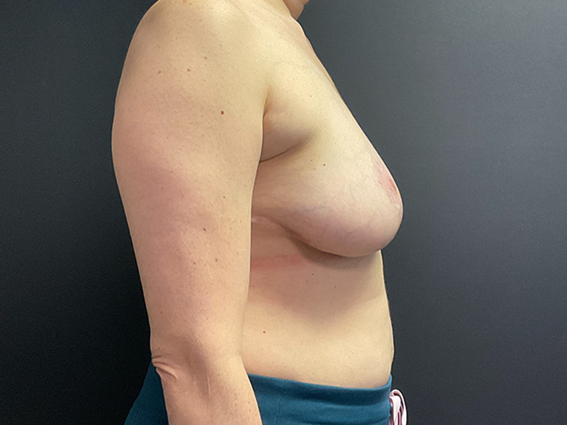 Breast Lift Before & After Image