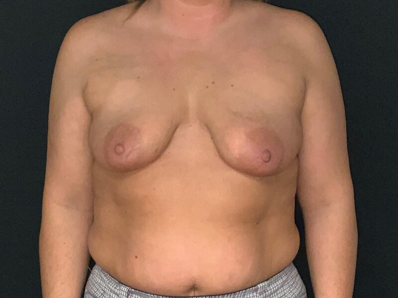 Breast Lift Before & After Image