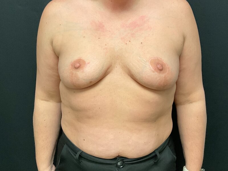 Breast Lift Before & After Image