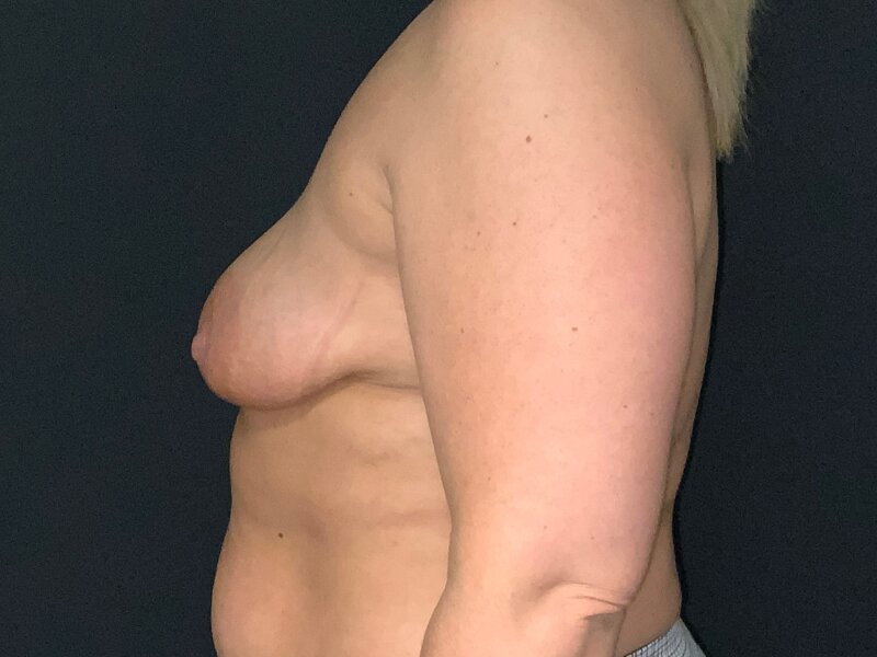 Breast Lift Before & After Image