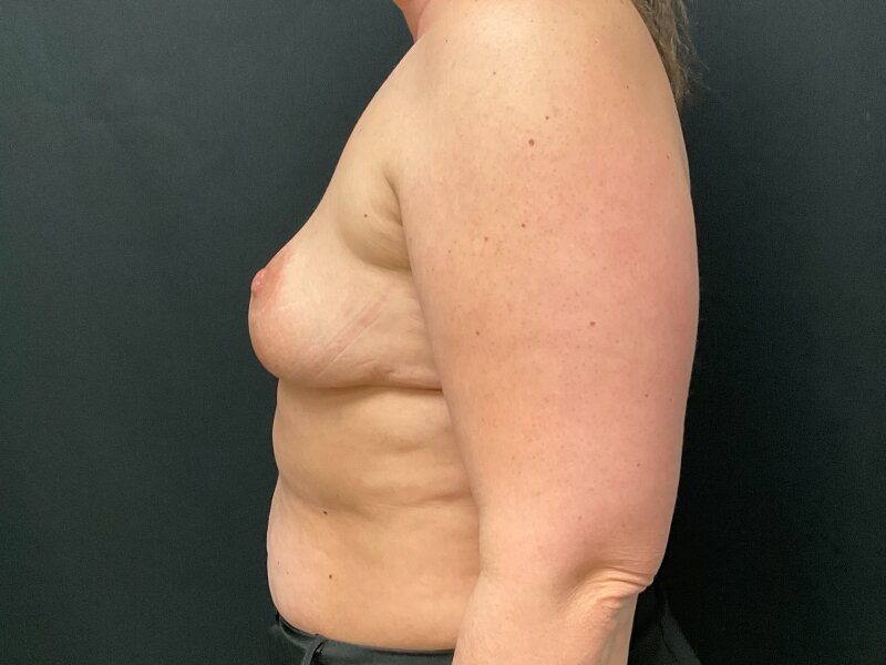 Breast Lift Before & After Image