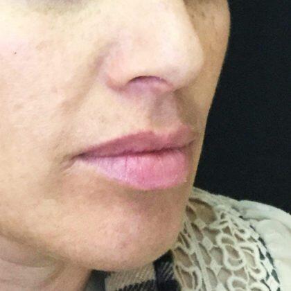 Lip Fillers Before & After Image