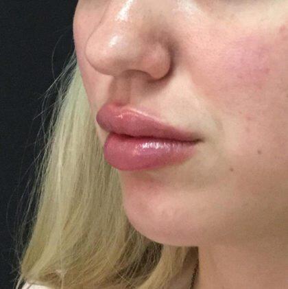 Lip Fillers Before & After Image