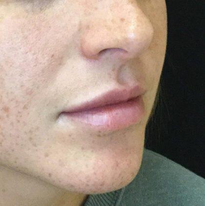 Lip Fillers Before & After Image