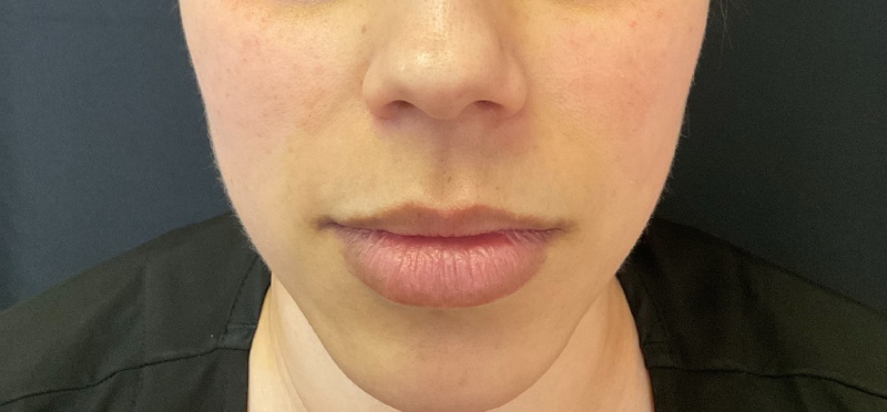 Lip Fillers Before & After Image