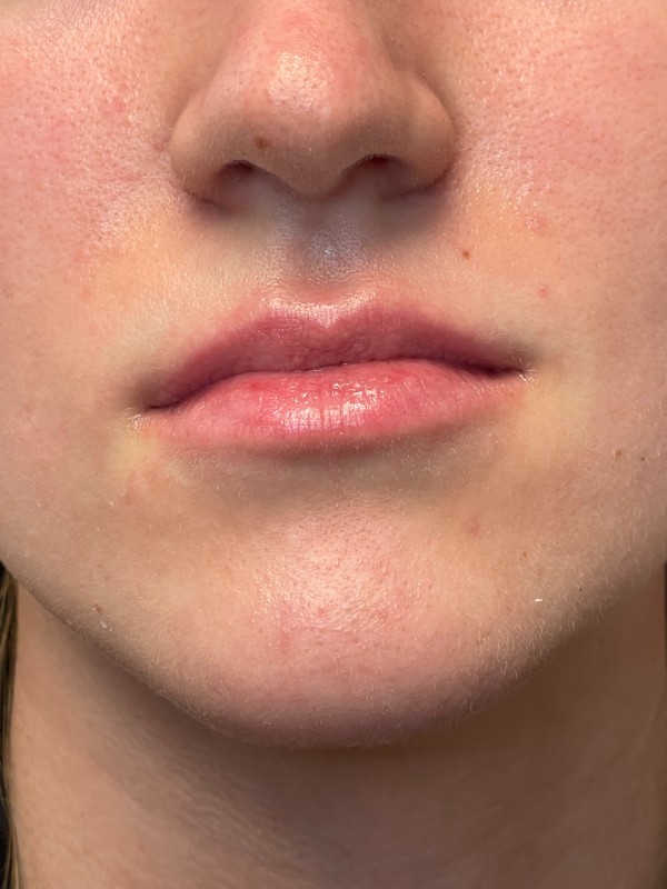 Lip Fillers Before & After Image