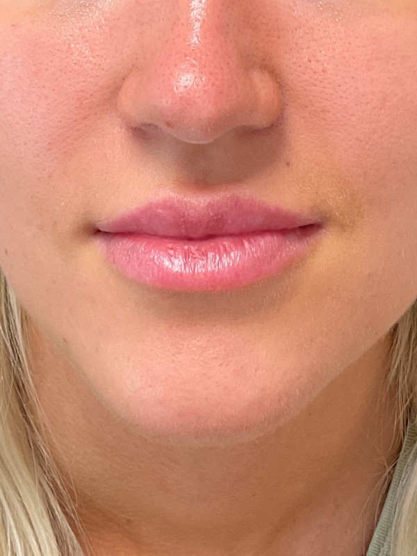 Lip Fillers Before & After Image