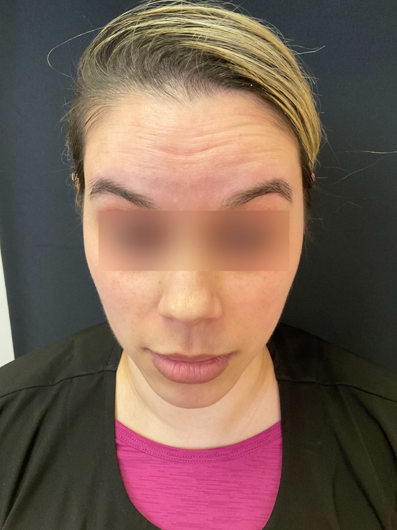 Botox Before & After Image