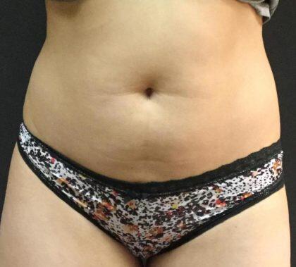 CoolSculpting Before & After Image