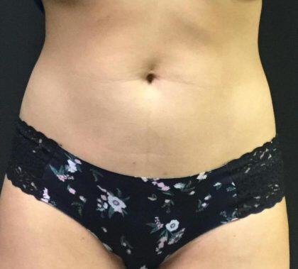 CoolSculpting Before & After Image