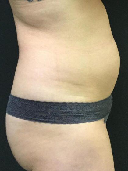 CoolSculpting Before & After Image