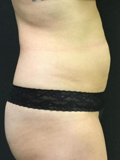 CoolSculpting Before & After Image