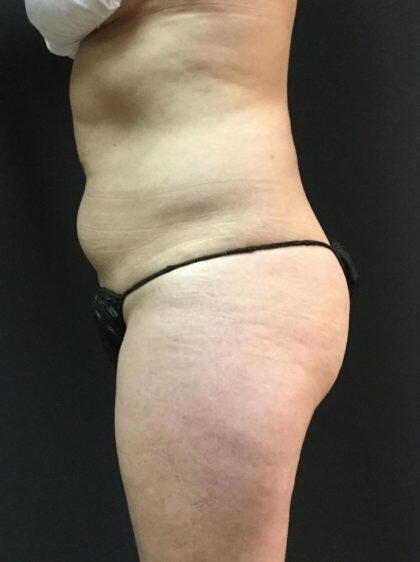 CoolSculpting Before & After Image