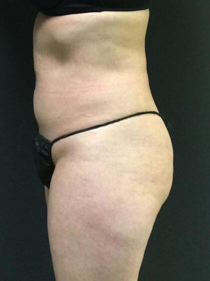 CoolSculpting Before & After Image