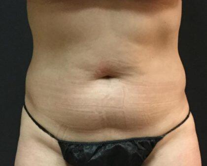 CoolSculpting Before & After Image