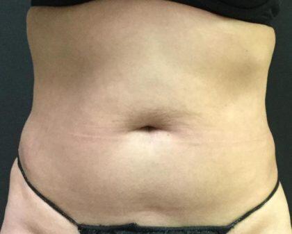 CoolSculpting Before & After Image