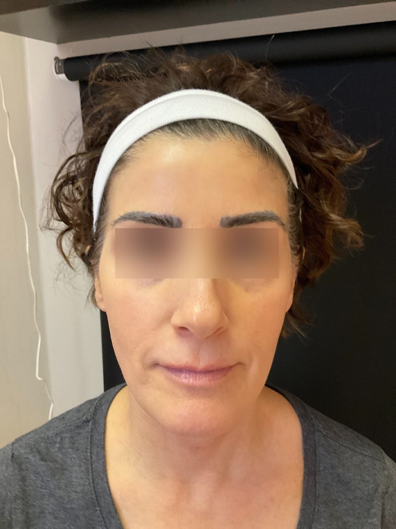 PRP Injections Before & After Image