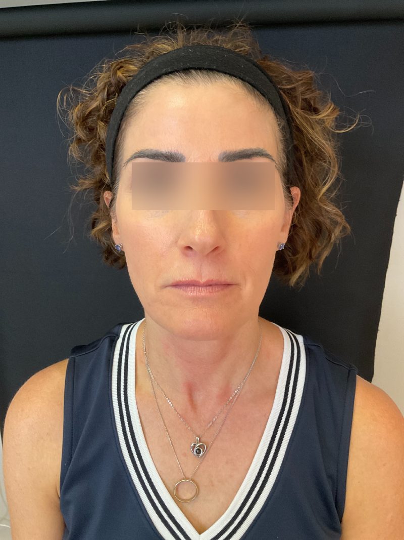 PRP Injections Before & After Image