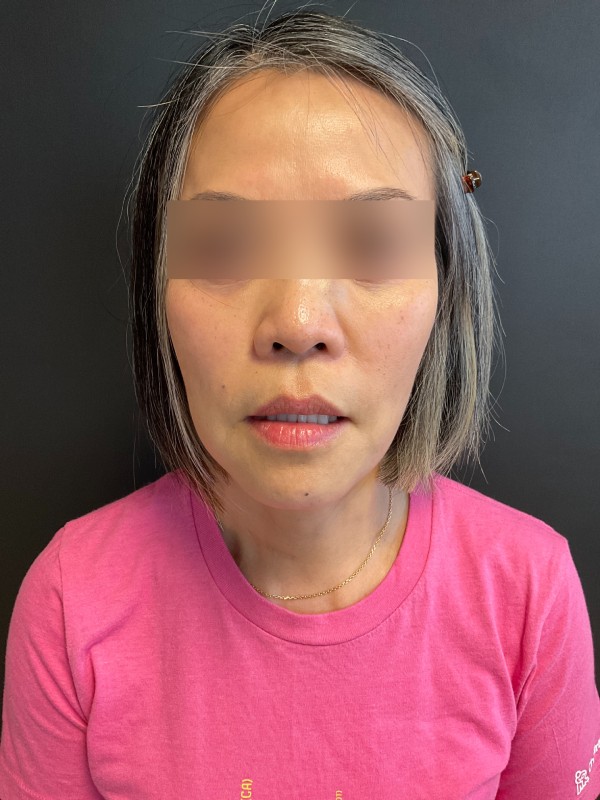 Restylane Before & After Image