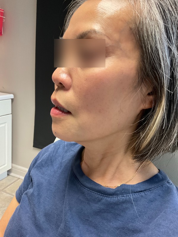 Restylane Before & After Image