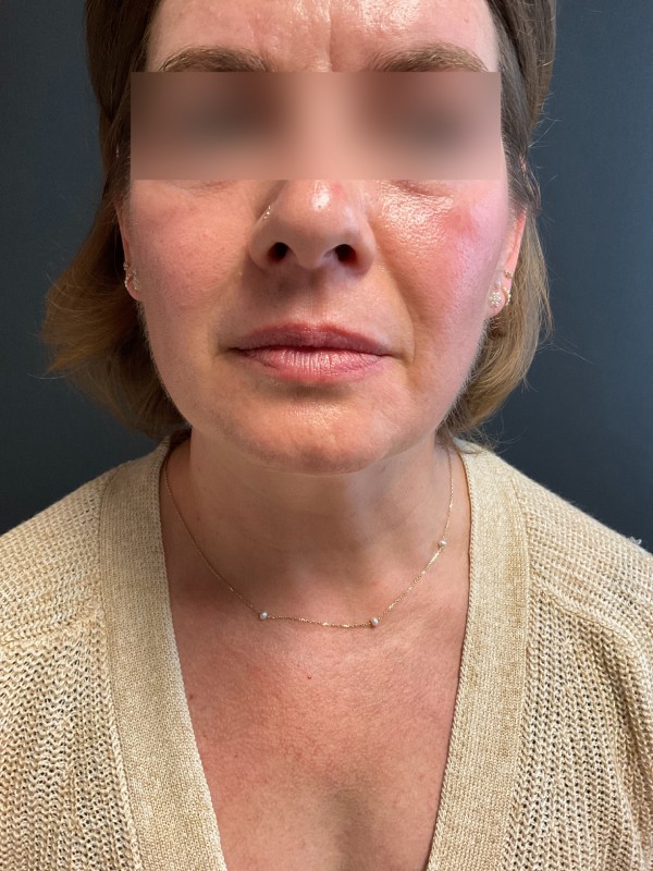 Restylane Before & After Image