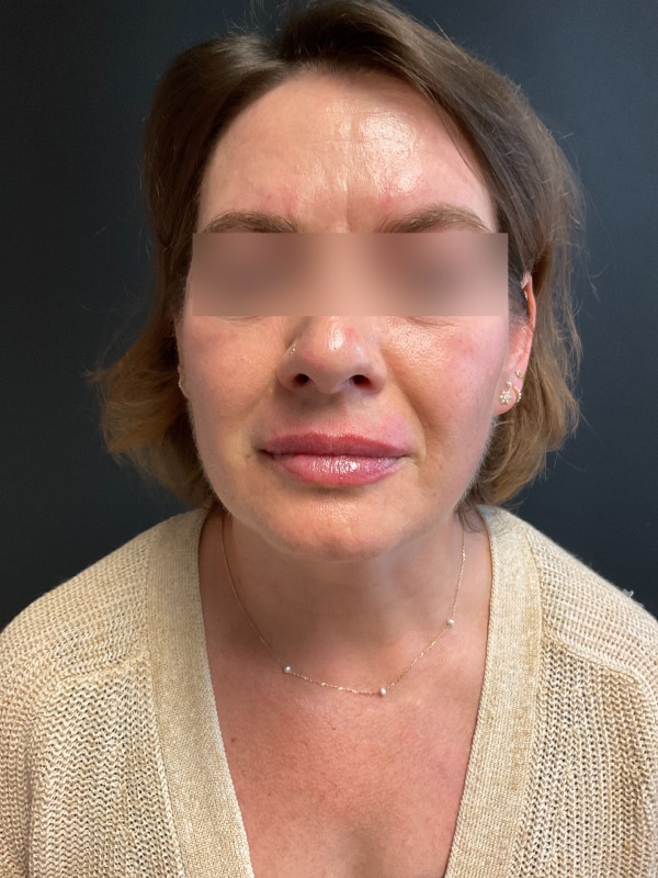 Restylane Before & After Image